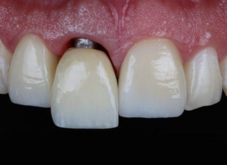 implantes dentales cañaveral