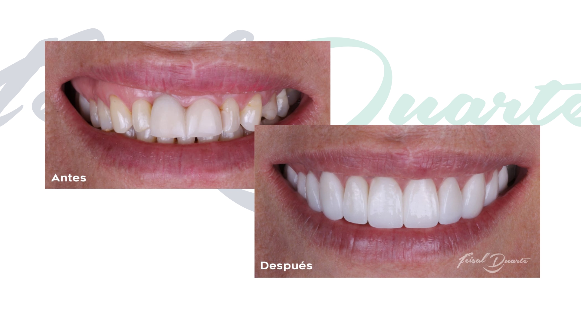 Diseño de sonrisa antes y después, diseño de sonrisa en bucaramanga, odontólogo en bucaramanga