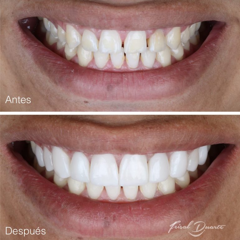 diseño de sonrisa en bucaramanga, diseño sonrisa cañaveral, dr Feisal Duarte, odontología estetica,