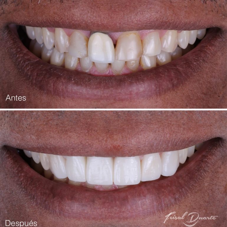 Implantes dentales bucaramanga, rehabilitación oral, odontología cañaveral, odontólogo, dr Feisal Duarte