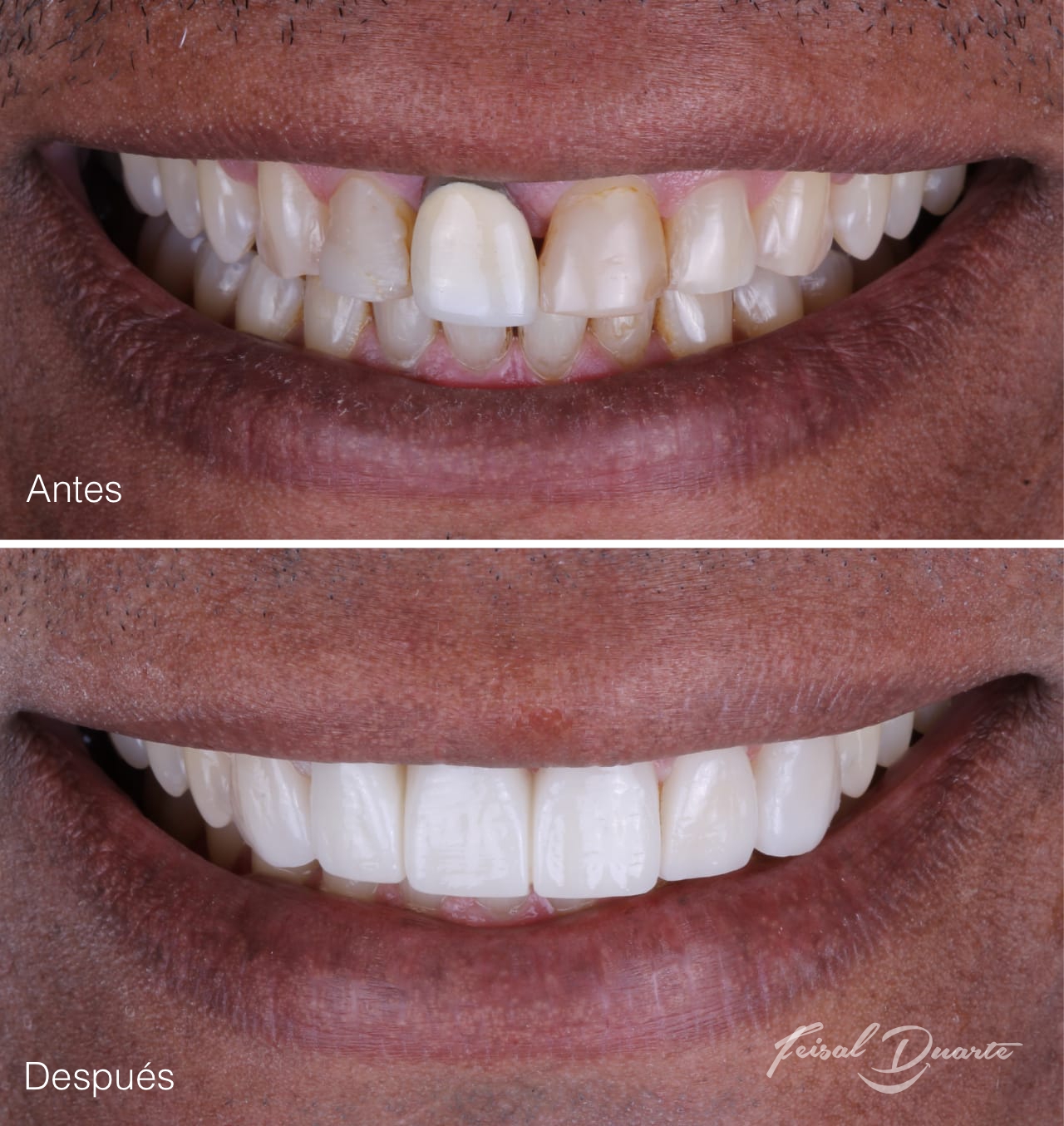 Implantes dentales bucaramanga, rehabilitación oral, odontología cañaveral, odontólogo, dr Feisal Duarte