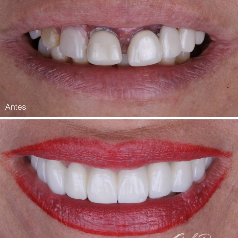 Implantes dentales bucaramanga, rehabilitación oral, odontología cañaveral, odontólogo, dr Feisal Duarte