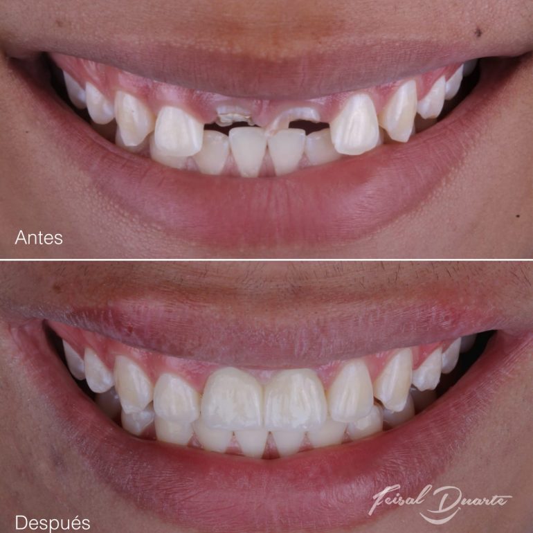 Implantes dentales bucaramanga, rehabilitación oral, odontología cañaveral, odontólogo, dr Feisal Duarte