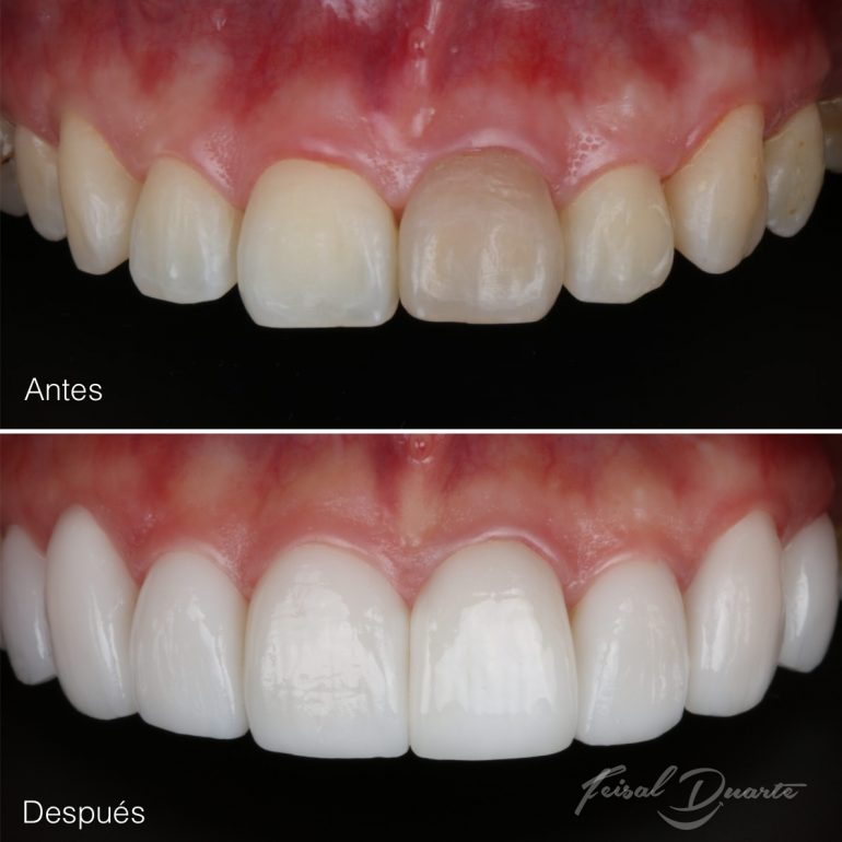 Diseño de sonrisa en Bucaramanga, Floridablanca, Cañaveral