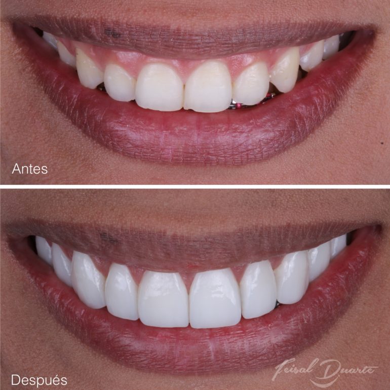 dr Feisal Duarte, odontologia estetica bucaramanga, diseño de sonrisa Floridablanca, cañaveral