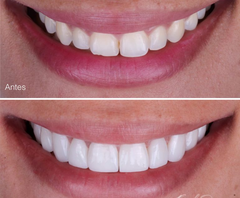 Diseño de sonrisa en cañaveral, dr Feisal Duarte, odontología bucaramanga