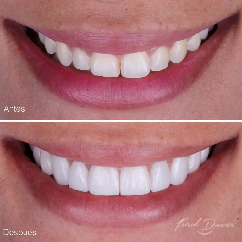 Diseño de sonrisa en cañaveral, dr Feisal Duarte, odontología bucaramanga