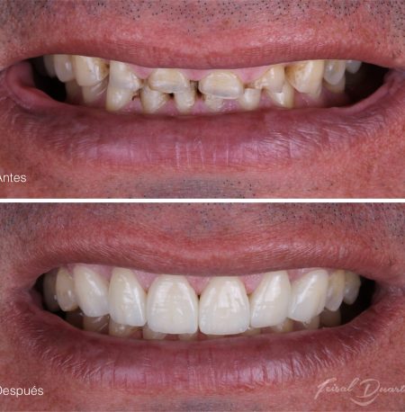 diseño de sonrisa bucaramanga, odontología cañaveral, dr Feisal Duarte, implantes dentales