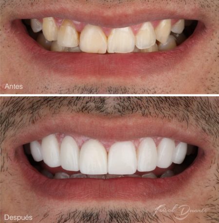 carillas cerámicas bucaramanga