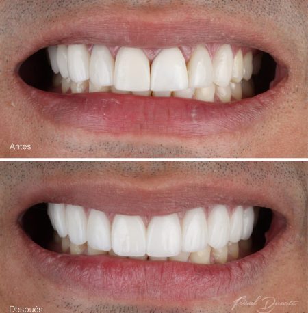 diseño de Sonrisa Bucaramanga