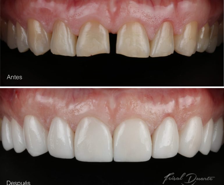 diseño de sonrisa bucaramanga, dr Feisal Duarte, rehabilitación oral, implantes dentales, antes y después, sonrisa antes y después