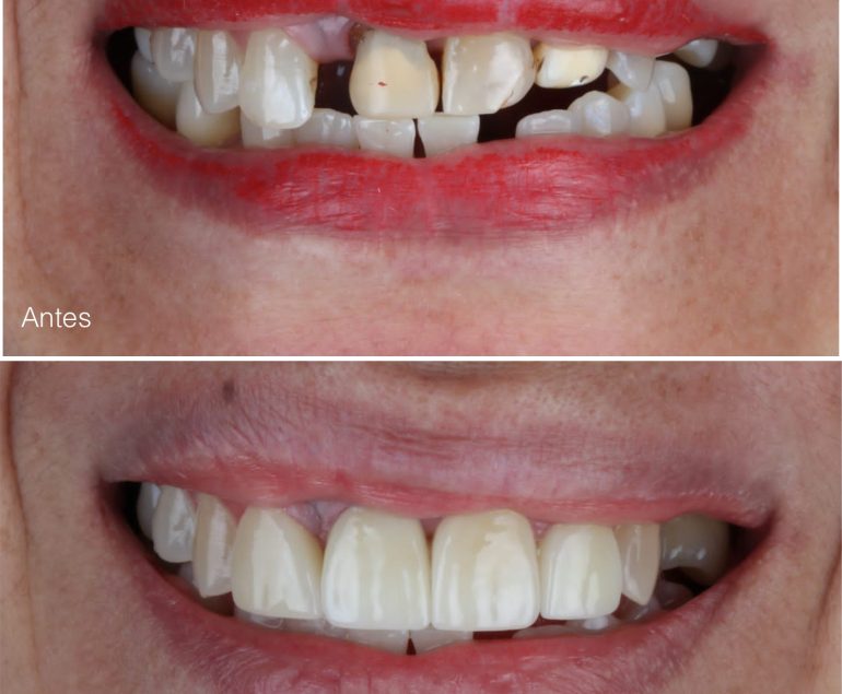 rehabilitación oral, implantes dentales, coronas bucaramanga, odontología Floridablanca