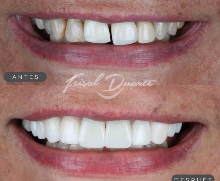 diseño de sonrisa en bucaramanga, dr feisal duarte, implantes dentales bucaramanga