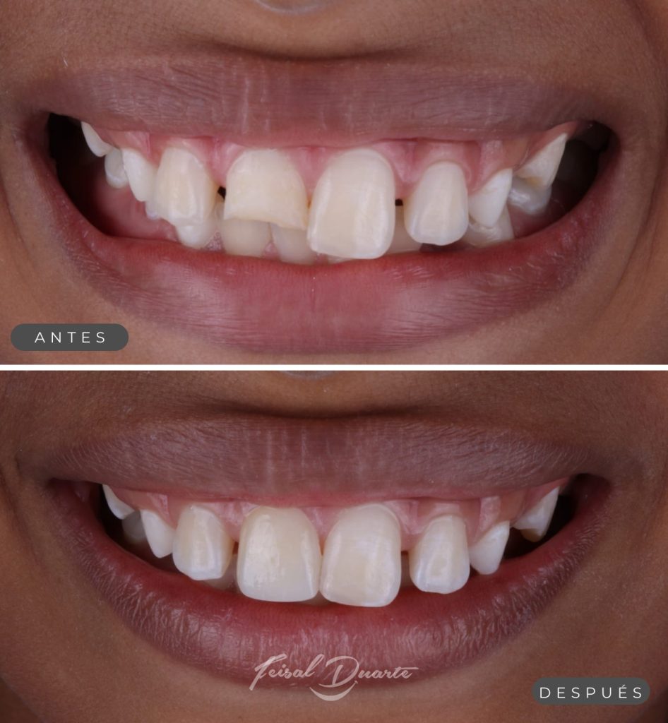 Odontologia estetica para niños bucaramanga