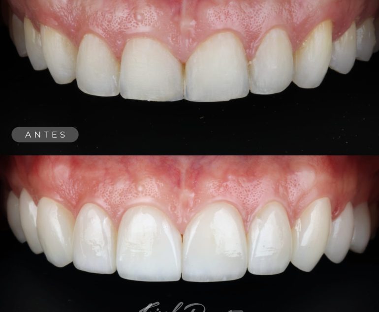 Diseño de sonrisa bucaramanga carillas