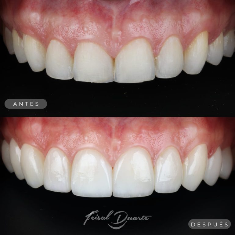 Diseño de sonrisa bucaramanga carillas