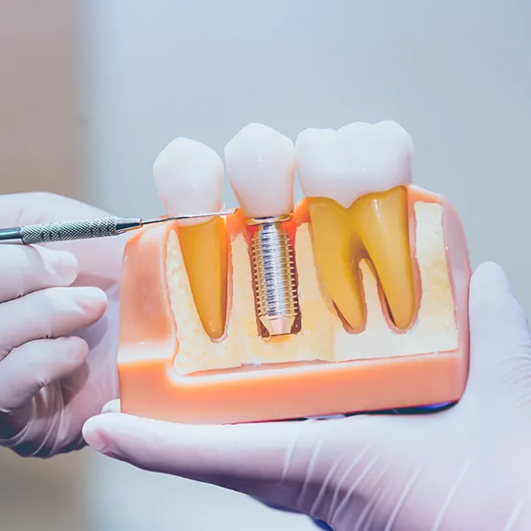 Img-servicios-Implantes dentales
