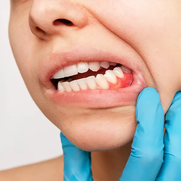 Img-servicios-Periodoncia