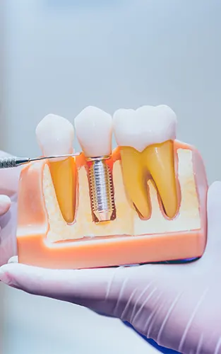 img-implantes-dentales-en-bucaramanga-1-LCP